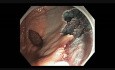 Coloscopie - Rectum - Tumeur à Extension Latérale Granulaire - EMR partie IV 