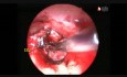 Excision endoscopique du glomus tympanique