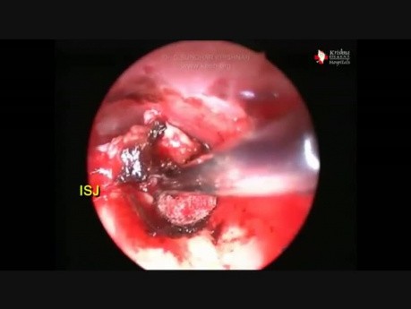 Excision endoscopique du glomus tympanique