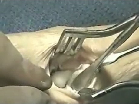 Prothèse Arthroplastique de l'Articulation Carpométacarpienne du Pouce