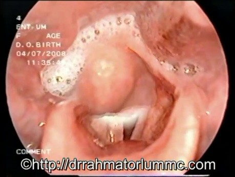 Accumulation de Salive dans l'Hypopharynx