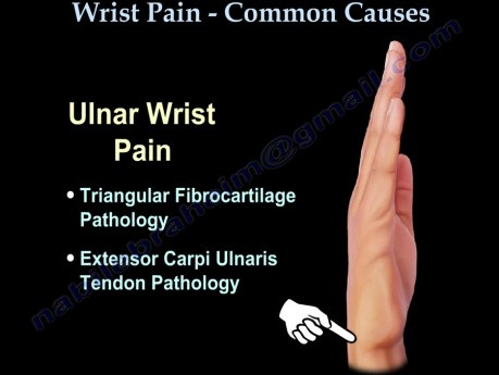 Causes de la douleur au poignet - conférence