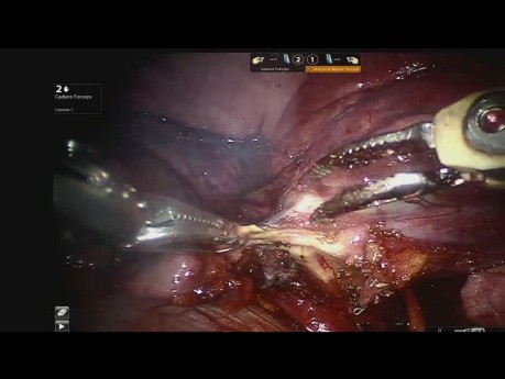 Lésion de l'Artère Pulmonaire lors de la Lobectomie Inférieure Gauche - Accident Vasculaire