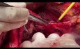 Les aspects techniques des procédures de la partie supérieure de l'abdomen dans la chirurgie avancée du cancer de l'ovaire