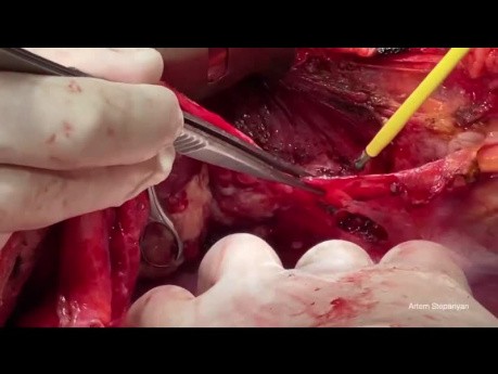 Les aspects techniques des procédures de la partie supérieure de l'abdomen dans la chirurgie avancée du cancer de l'ovaire