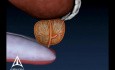 Biopsie de prostate - Animation médicale en 3D