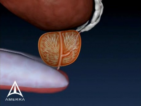 Biopsie de prostate - Animation médicale en 3D