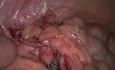 Appendicectomie par méthode d'incision unique