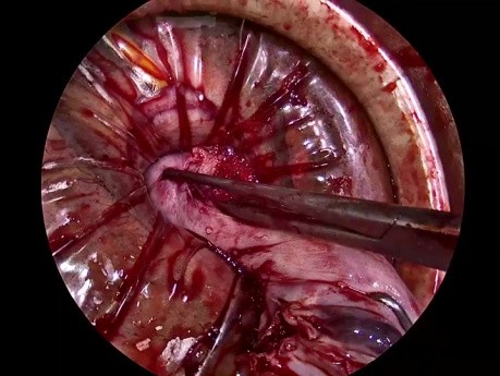 Morcellement Utérin par Voie Vaginale (Gros utérus fibromateux)