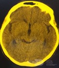  Ventriculostomie endoscopique du troisième ventricule dans un cas bénin du syndrome d'Aicardi avec hydrocéphalie obstructive et malformation de Chiari de type 1.