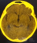  Ventriculostomie endoscopique du troisième ventricule dans un cas bénin du syndrome d'Aicardi avec hydrocéphalie obstructive et malformation de Chiari de type 1.