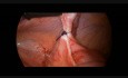 Prise en charge de l'invagination intestinale par coelioscopie chez un garçon de 5 ans