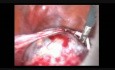 Carcinome endométrioïde de l'ovaire - prise en charge laparoscopique