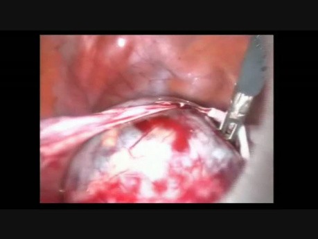 Carcinome endométrioïde de l'ovaire - prise en charge laparoscopique