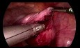 Myomectomie laparoscopique