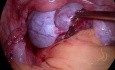 Ovariectomie Laparoscopique (Kyste Ovarien) [Vidéo Courte]
