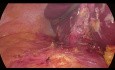 Drainage d'abcès hépatique (segment 7) par laparoscopie et cholécystectomie chez un patient très obèse (IMC 70)