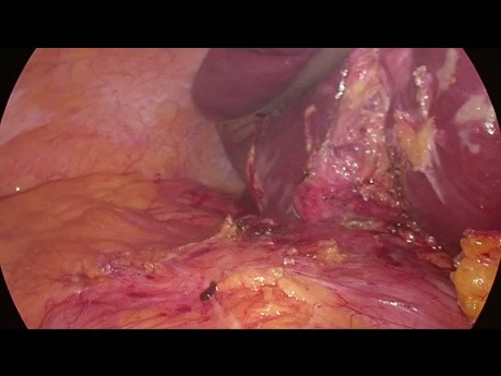 Drainage d'abcès hépatique (segment 7) par laparoscopie et cholécystectomie chez un patient très obèse (IMC 70)