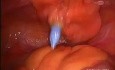 Hystérectomie Laparoscopique avec Curage Ganglionnaire Pelvien chez une Patiente avec un IMC à 65