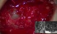 Adhésiolyse L2/L3/L4 + Ablation de Volumineuses Hernies Discales : L2/L3/4 TLIF : L2/3 (Droite), L3/4 (Gauche)
