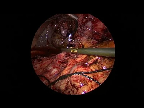 Exploration laparoscopique avec cholédochotomie à l'aide d'instruments d'un diamètre de 3 mm