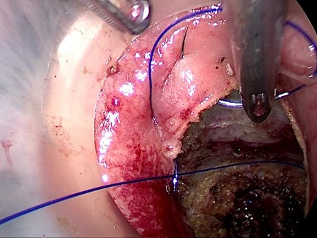 la résection chirurgicale du cancer du rectum en utilisant l'exérèse totale du mésorectum par voie transanale  (TaTME).