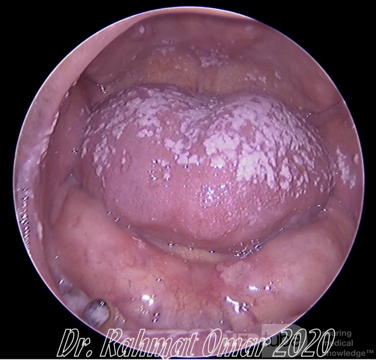 Muguet Buccal (Candidose)