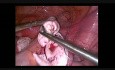 Ablation du kyste mucineux avec reconstruction ovarienne