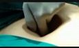 Pneumopéritoine ouvert