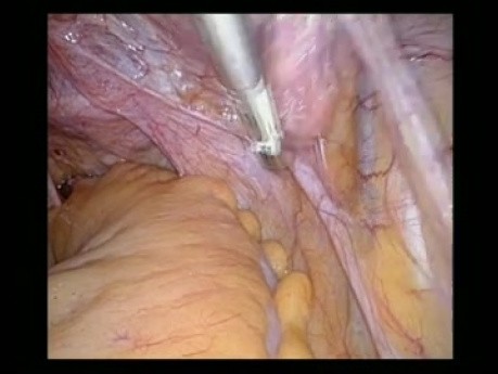 Hystérectomie avec Annexectomie