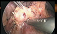 Tumeurs endocrines du pancréas