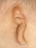 Microtie de l'oreille [gauche]