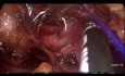 Réparation de la veine cave pendant la néphrectomie partielle rétropéritonéoscopique