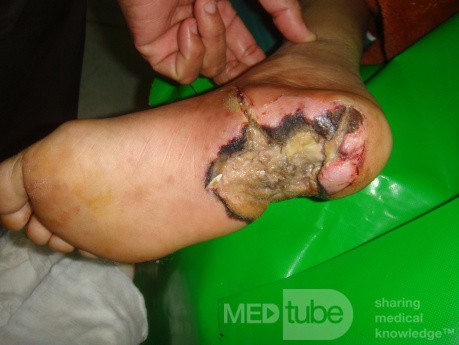 L'ulcère du pied diabétique, une infection du pied 2  