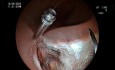 Fermeture de Perforation - L'Art du Clippage