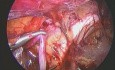 Cure chirurgicale de la varicocèle gauche par abord laparoscopique