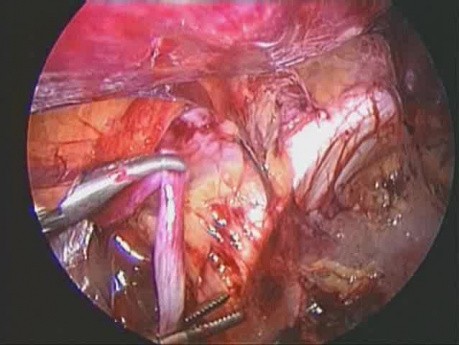 Cure chirurgicale de la varicocèle gauche par abord laparoscopique