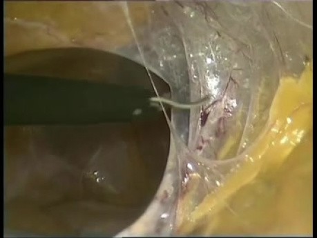 Adhésiolyse laparoscopique chez un patient présentant un syndrome d'adhérence sévère après des interventions multiples à cause de la péritonite
