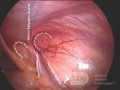 Anatomie de la région inguinale - vue laparoscopique 
