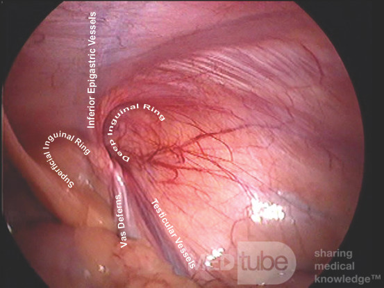 Anatomie de la région inguinale - vue laparoscopique 