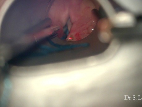 Traitement chirurgical de la paralysie bilatérale des cordes vocales