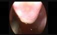 Suppression du polype antrochoanal par le rasoir