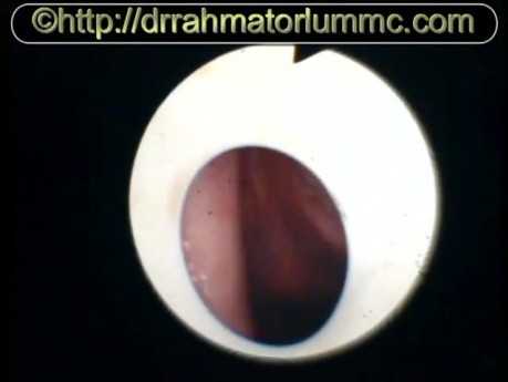 Vue de Vibrations des Cordes Vocales 
