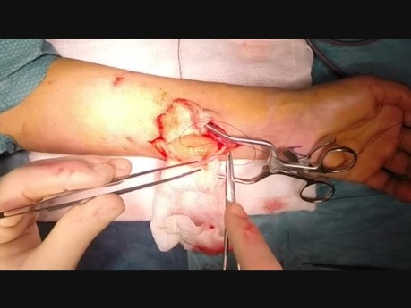 Excision d'une tumeur de schwannome