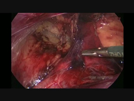Cure de hernie inguinale par voie laparoscopique TAPP (trocart de 5 mm)