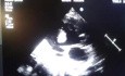 Énorme Thrombus dans le Ventricule Gauche