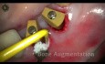 Extraction et implantation immédiate avec des lasers