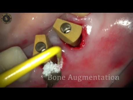 Extraction et implantation immédiate avec des lasers