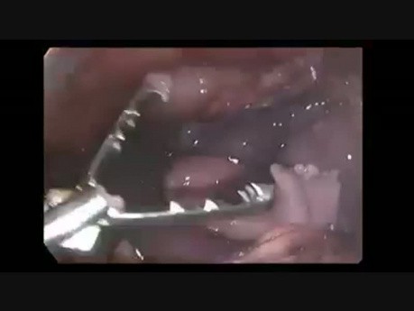 Grossesse développée dans une corne utérine rudimentaire non communicante