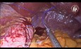 Gastrectomie Laparoscopique avec Omentopexie et Fixation de la Paroi Postérieure Gastrique pour Détordre l'Estomac Restant